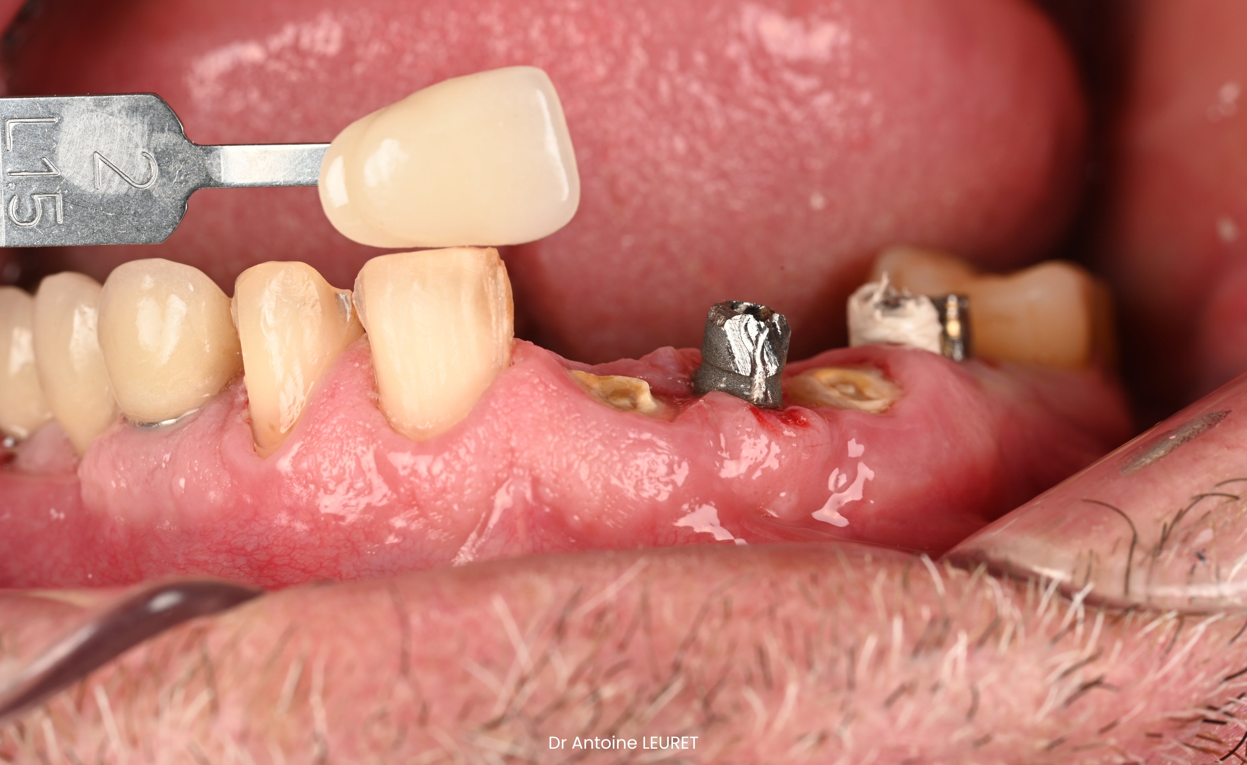 Restaurations directes & indirectes - Saison 1