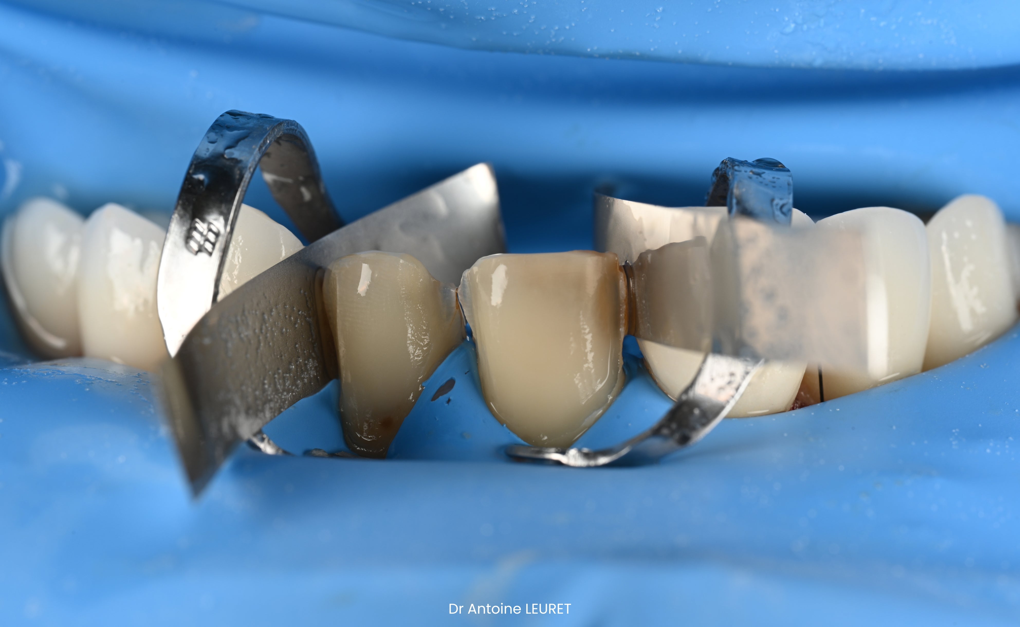 Restaurations directes & indirectes - Saison 1