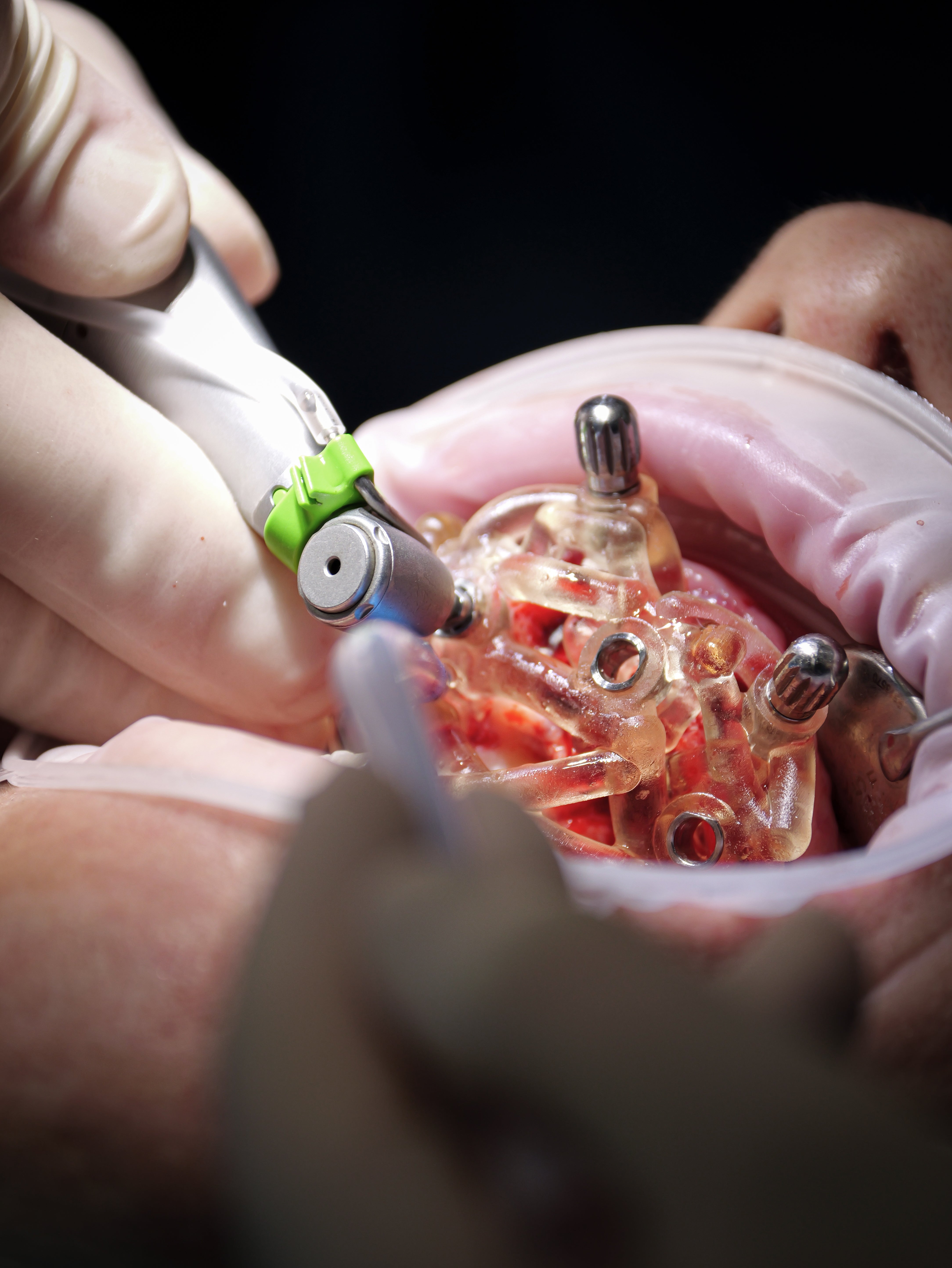 Implantologie et chirurgie pré-implantaire - Saison 2