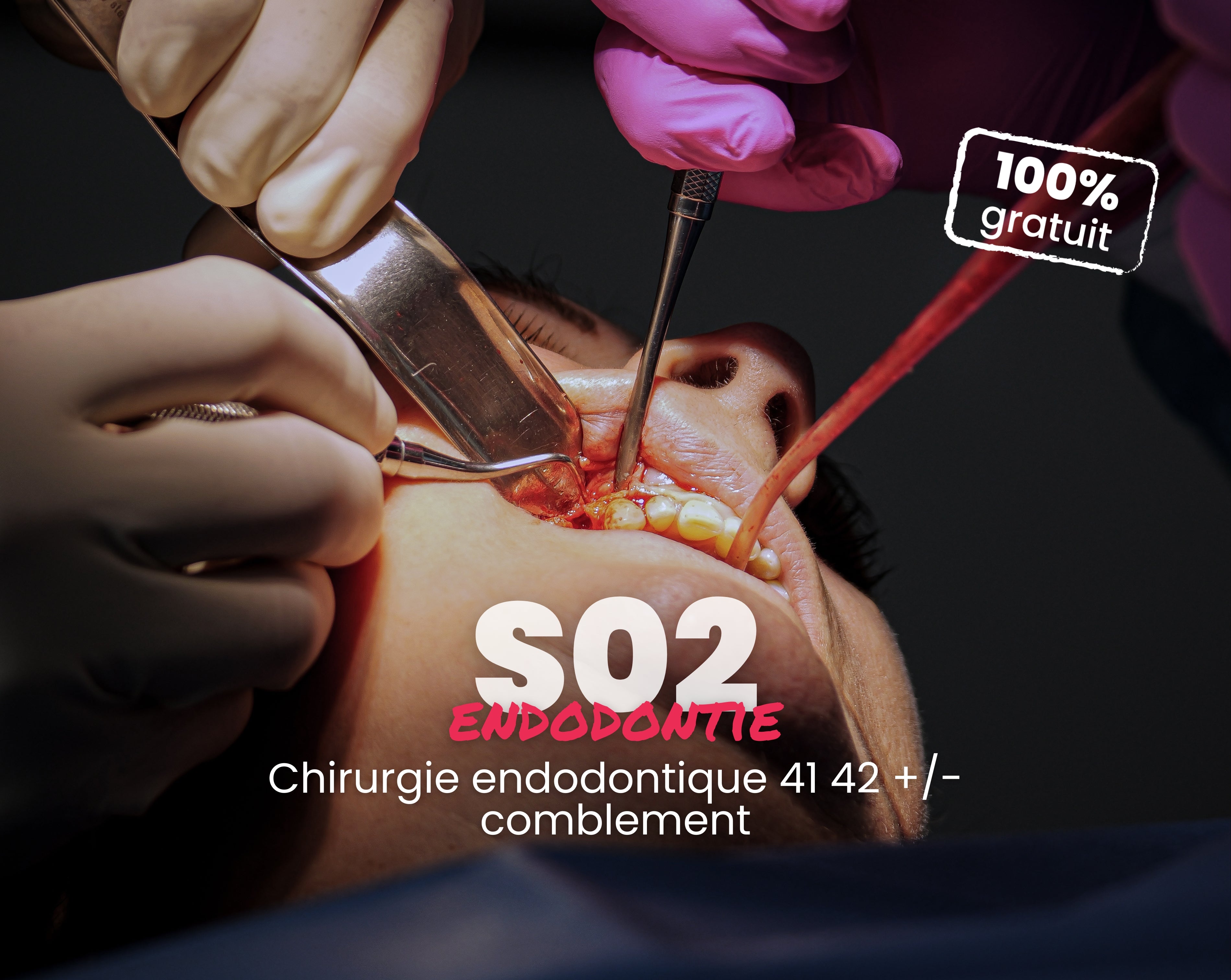 Extrait offert - MasterClass Endodontie Saison 2 - Chirurgie endodontique 41 42 +/- comblement