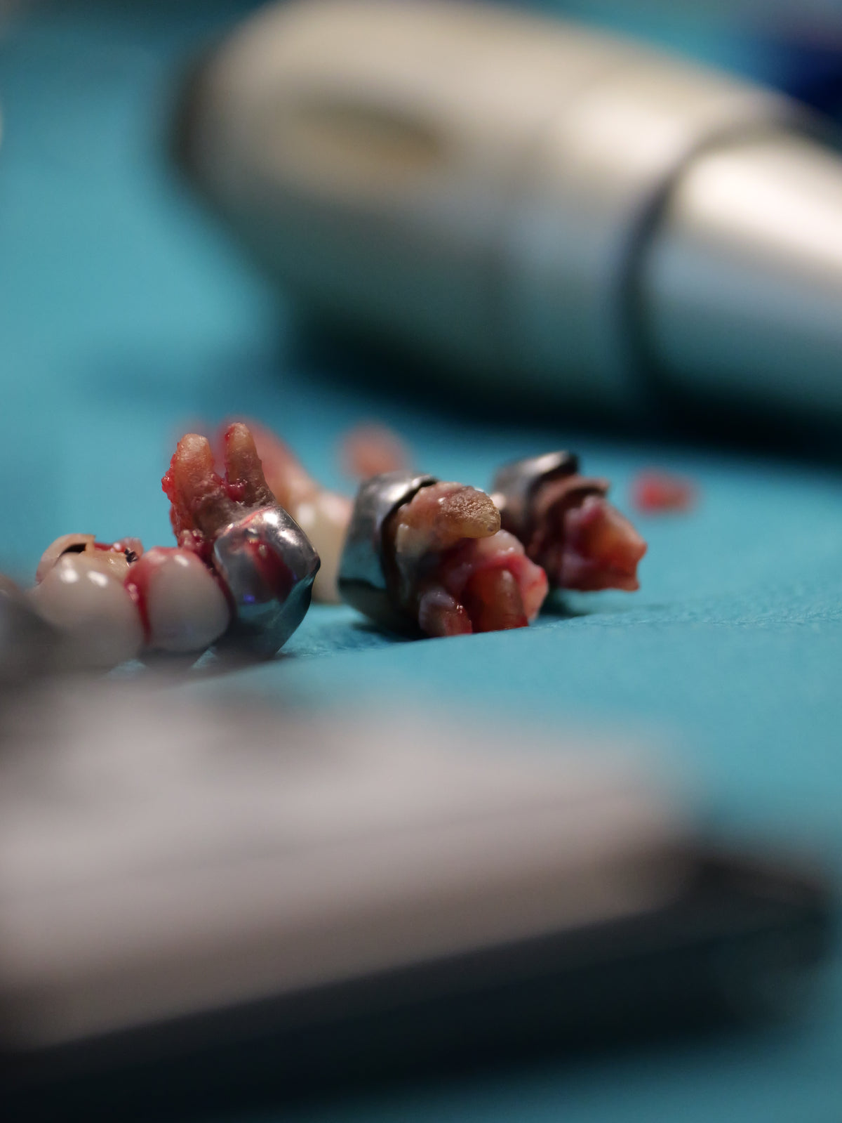 Implantologie et chirurgie pré-implantaire - Saison 4