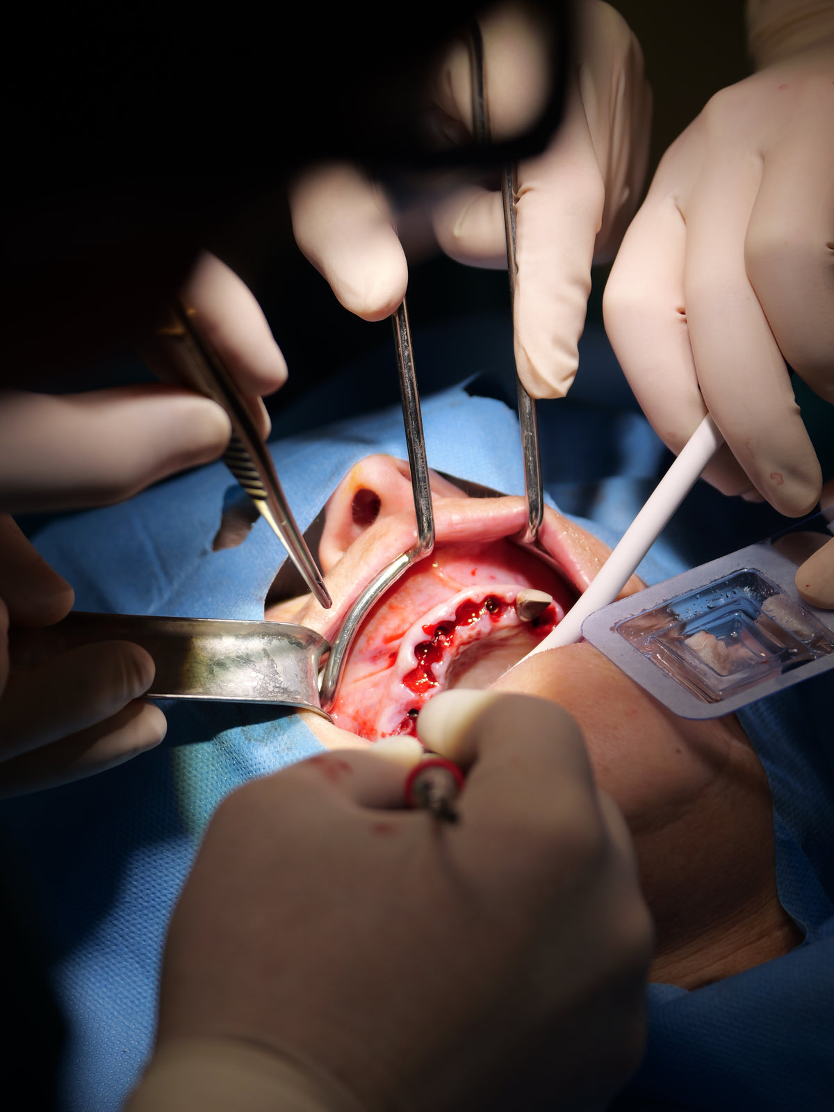 Implantologie et chirurgie pré-implantaire - Saison 4
