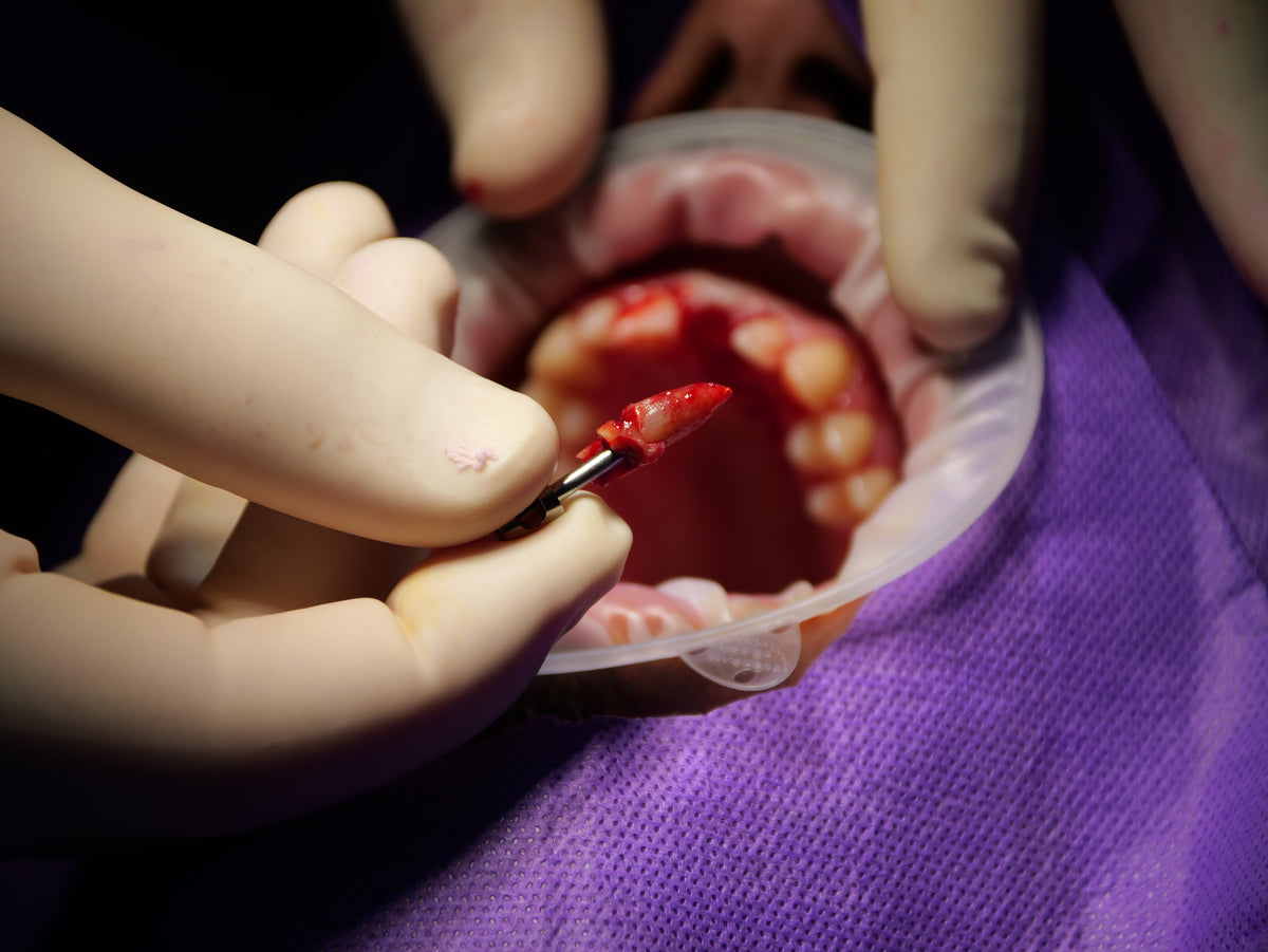 Implantologie et chirurgie pré-implantaire - Saison 4