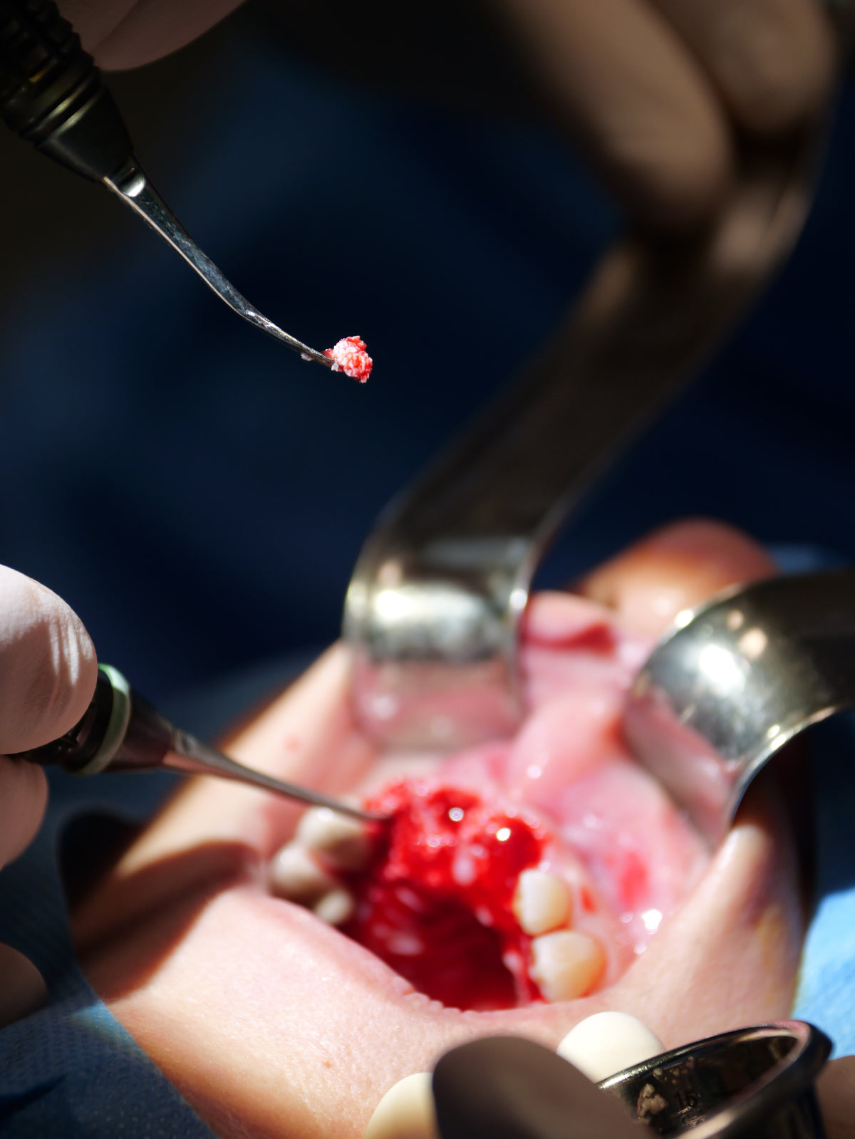 Implantologie et chirurgie pré-implantaire - Saison 4
