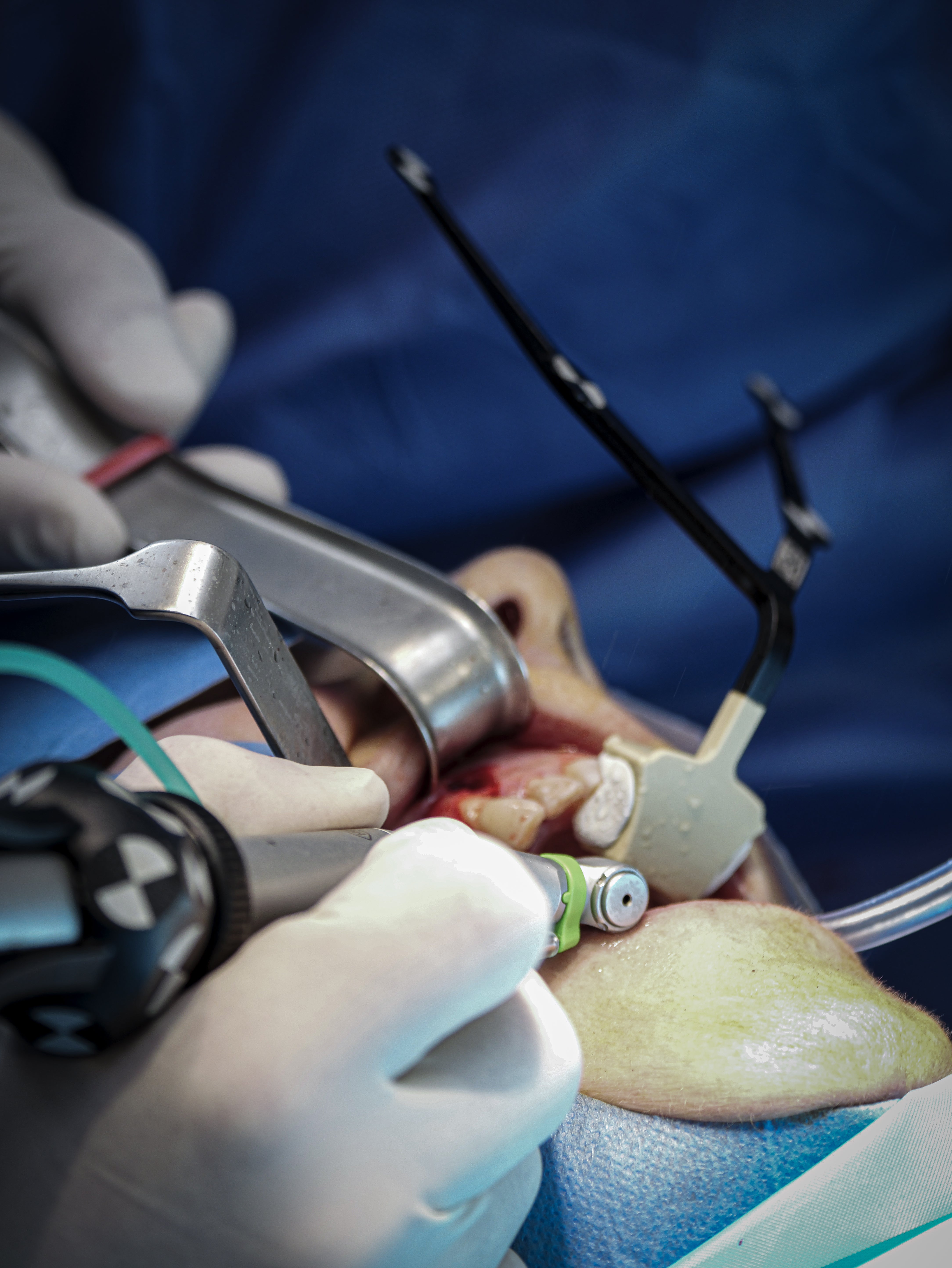 Implantologie et chirurgie pré-implantaire - Saison 2