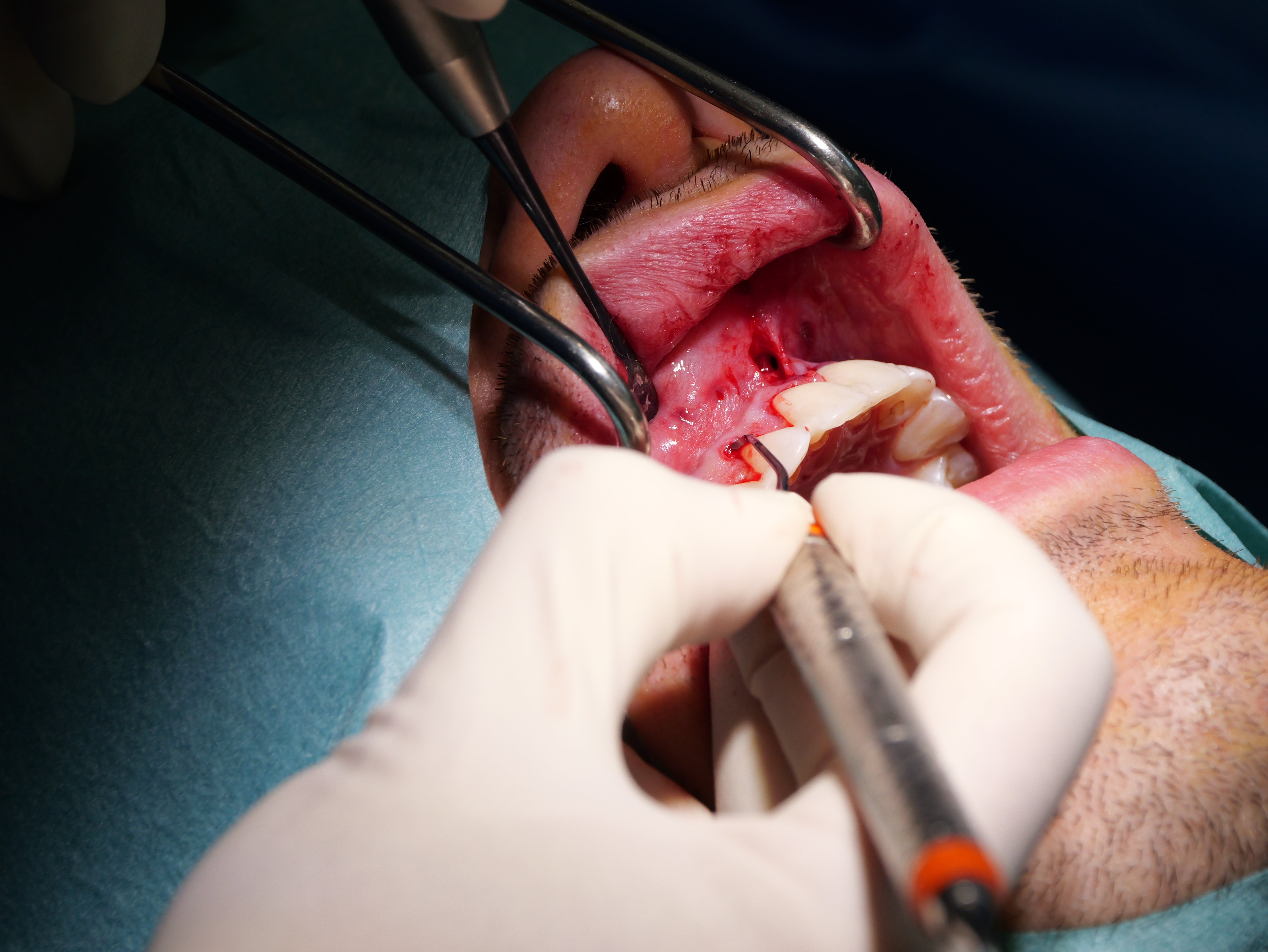 Parodontie & Chirurgie muco-gingivale - Saison 1