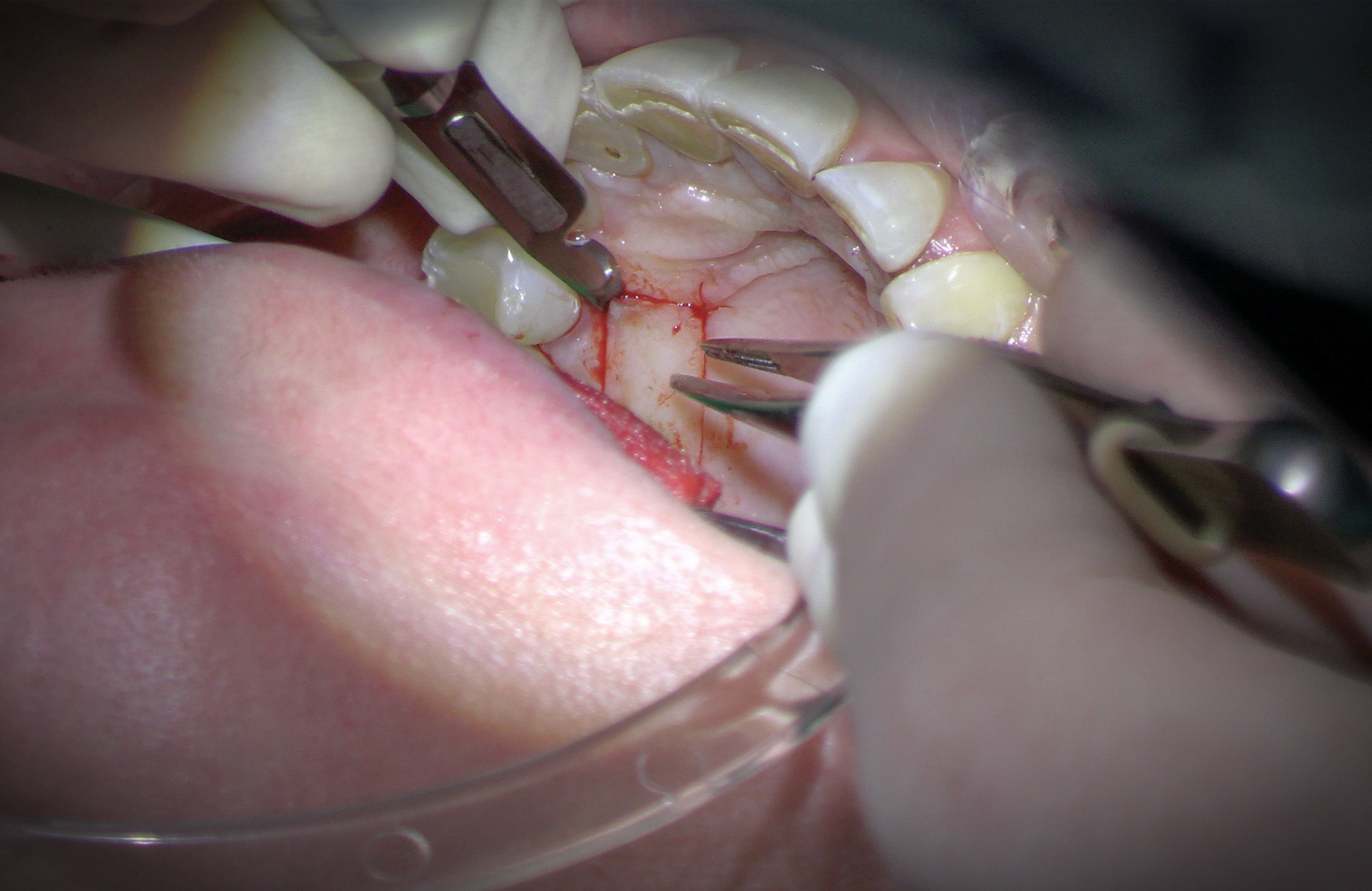 Parodontie & Chirurgie muco-gingivale - Saison 1