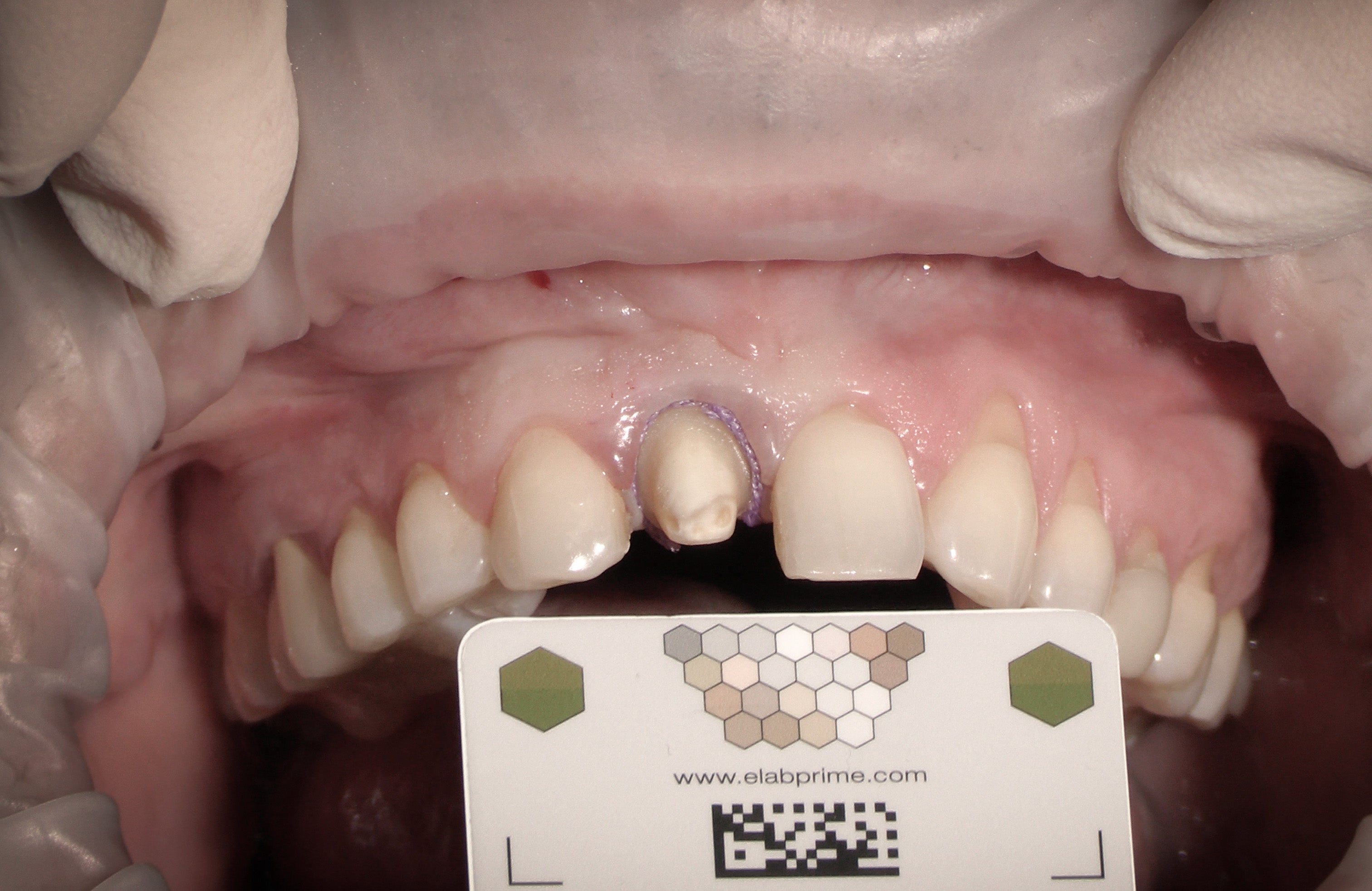 Restaurations directes & indirectes - Saison 1