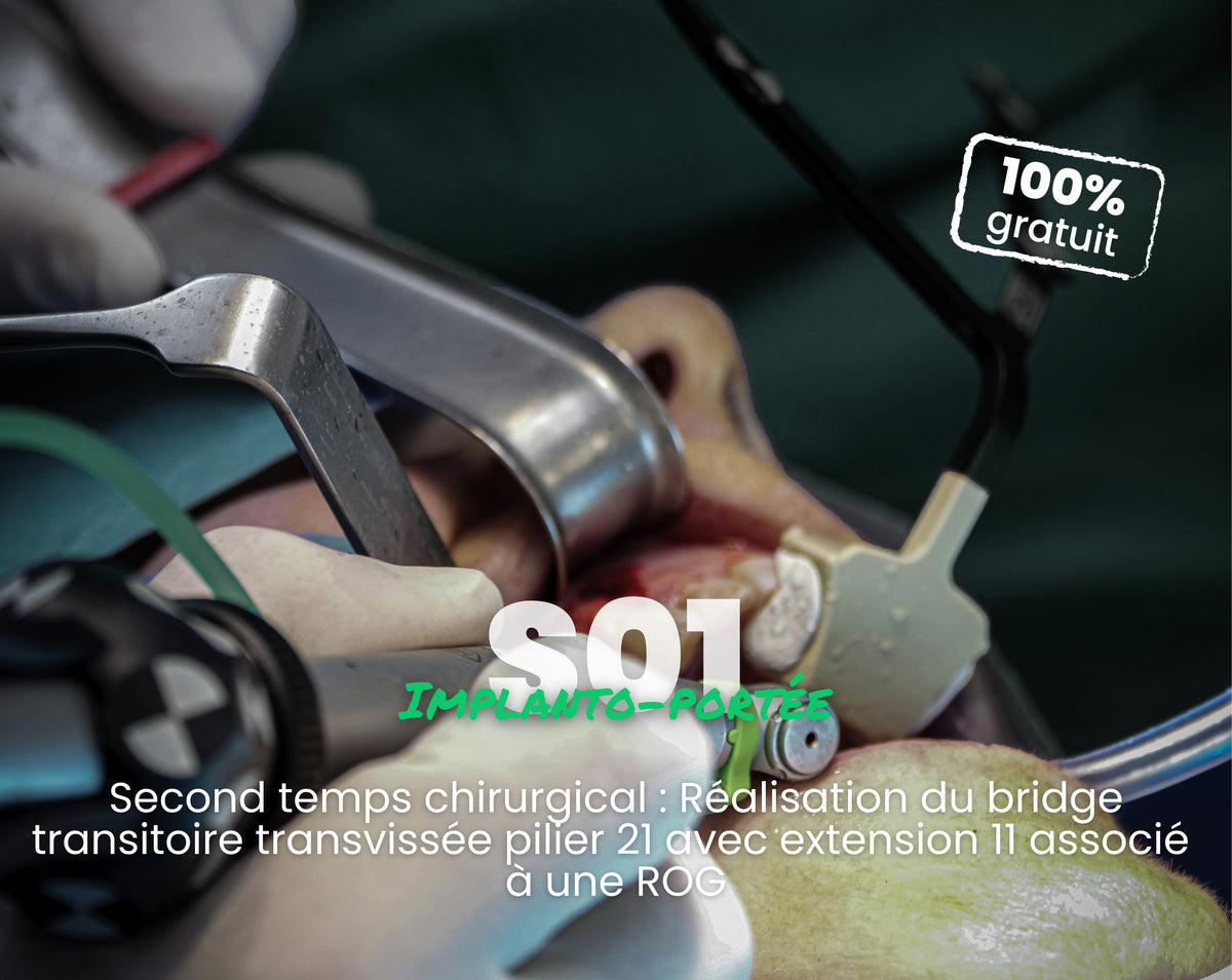 Extrait offert - MasterClass Implanto-portée Saison 1 - Second temps chirurgical : Réalisation du bridge transitoire transvissée pilier 21 avec extension 11 associé à une ROG