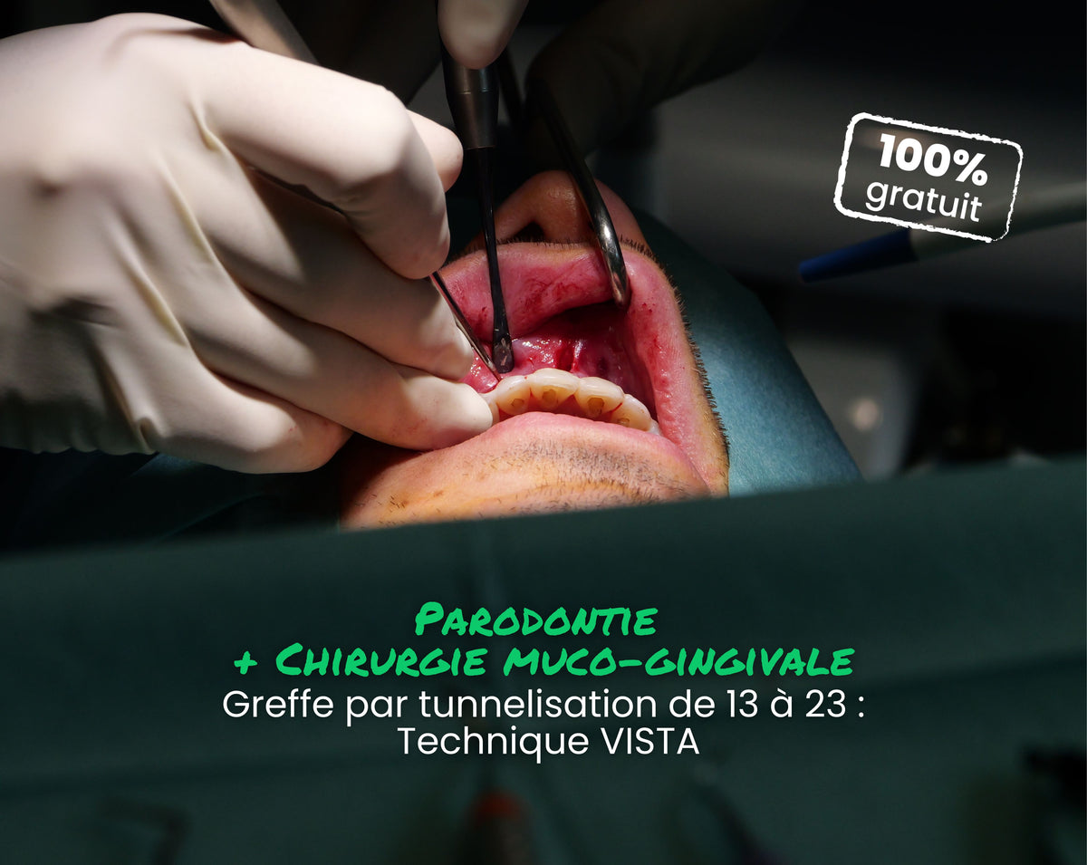 Extrait offert - MasterClass Parodontie & Chirurgie muco-gingivale - Greffe par tunnelisation de 13 à 23 : Technique VISTA