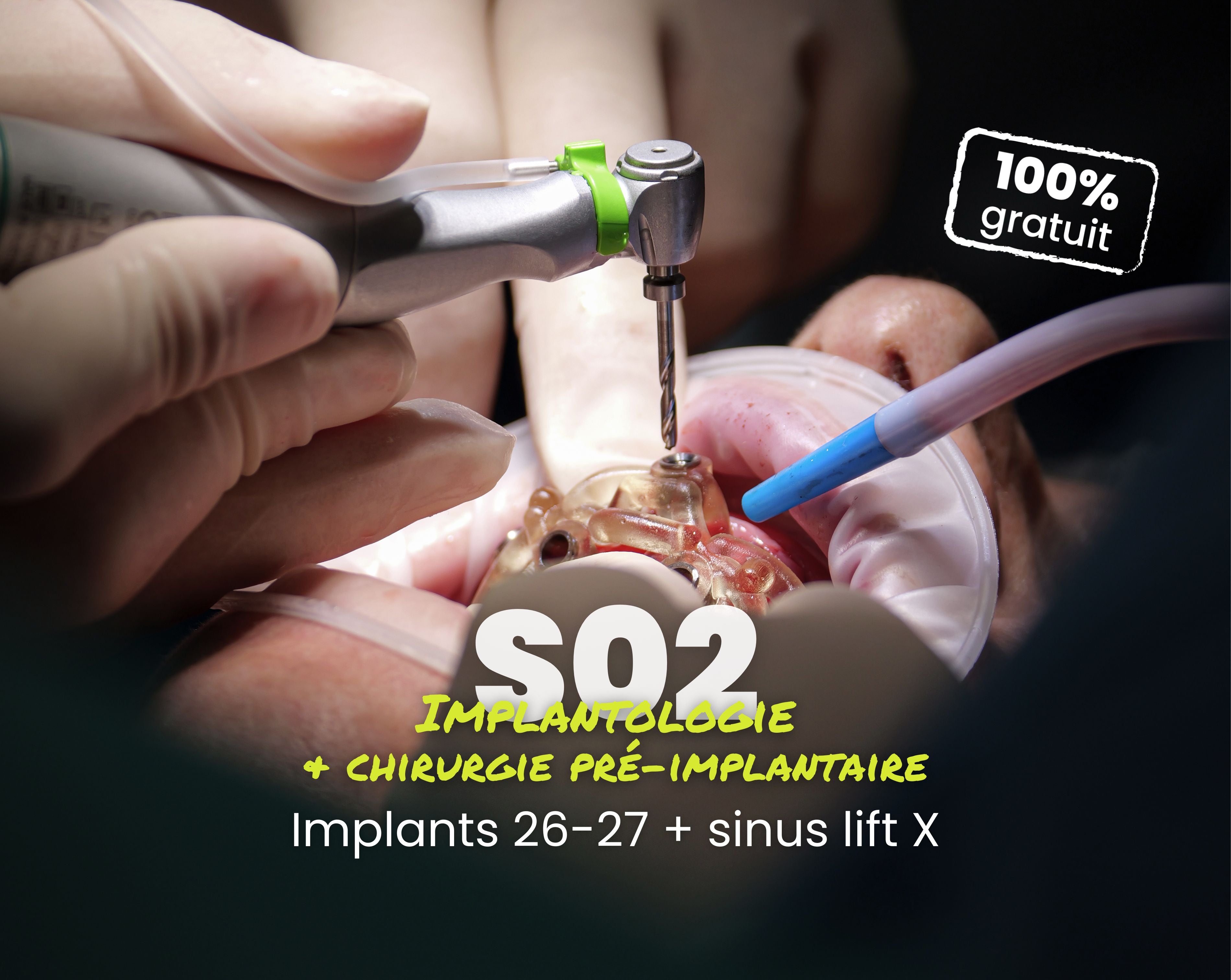 Extrait offert - MasterClass Implantologie Saison 2 - Implants 26-27 + sinus lift X