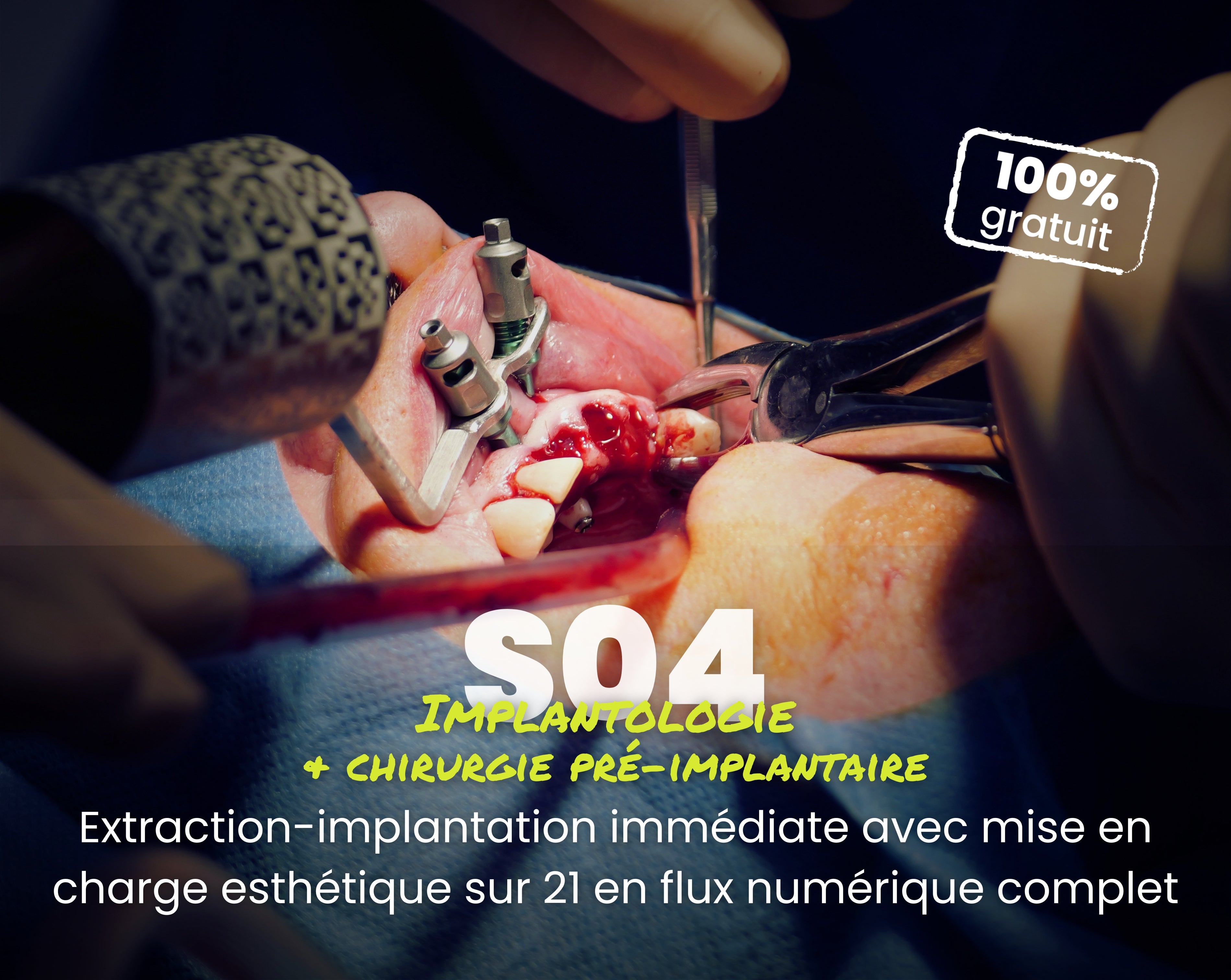 Extrait offert - MasterClass Implantologie Saison 4 - Extraction-implantation immédiate avec mise en charge esthétique sur 21 en flux numérique complet