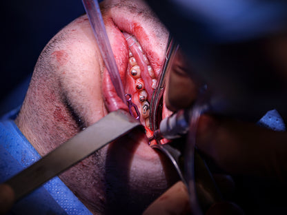 Implantologie et chirurgie pré-implantaire - Saison 1