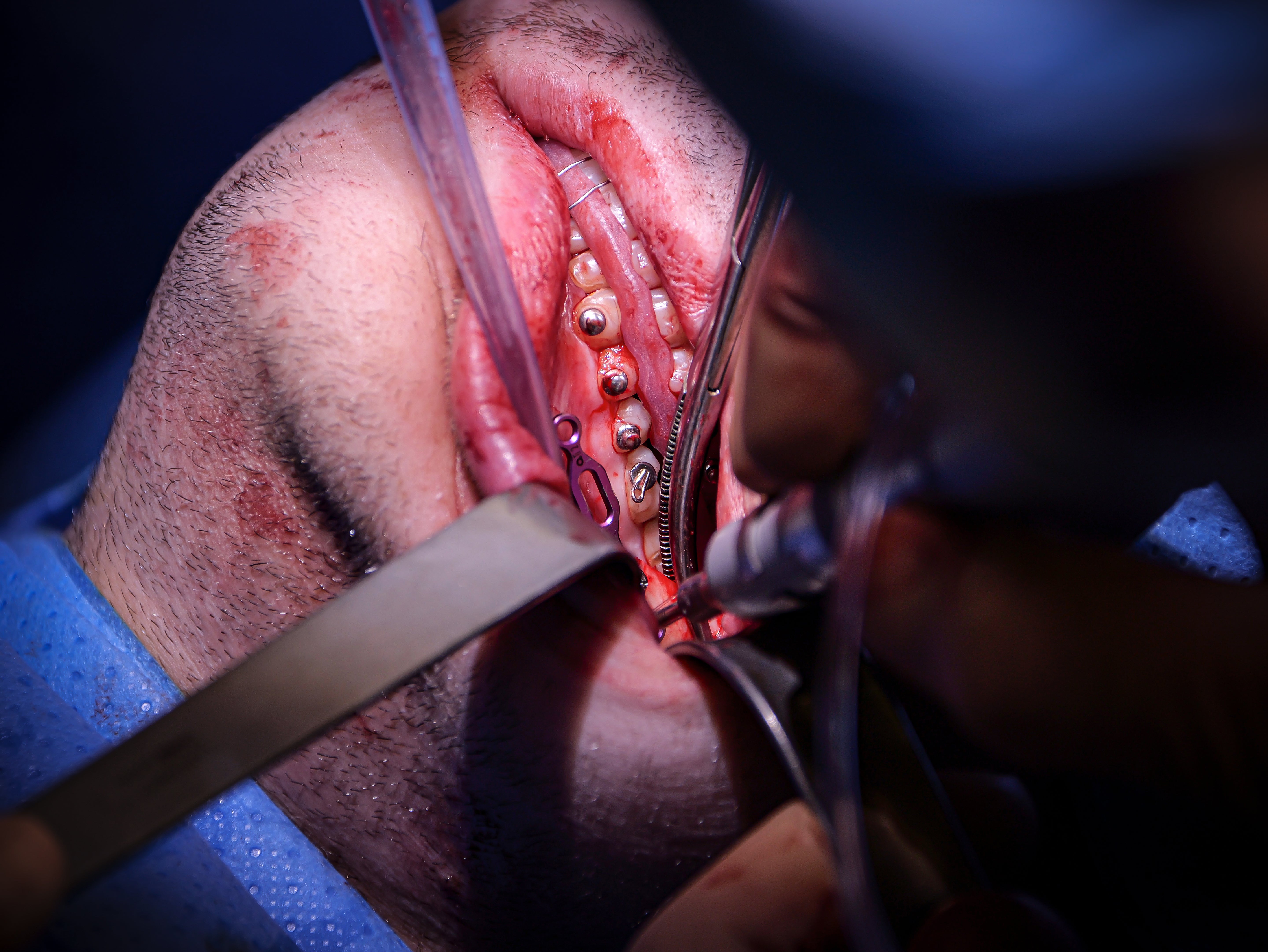 Implantologie et chirurgie pré-implantaire - Saison 1