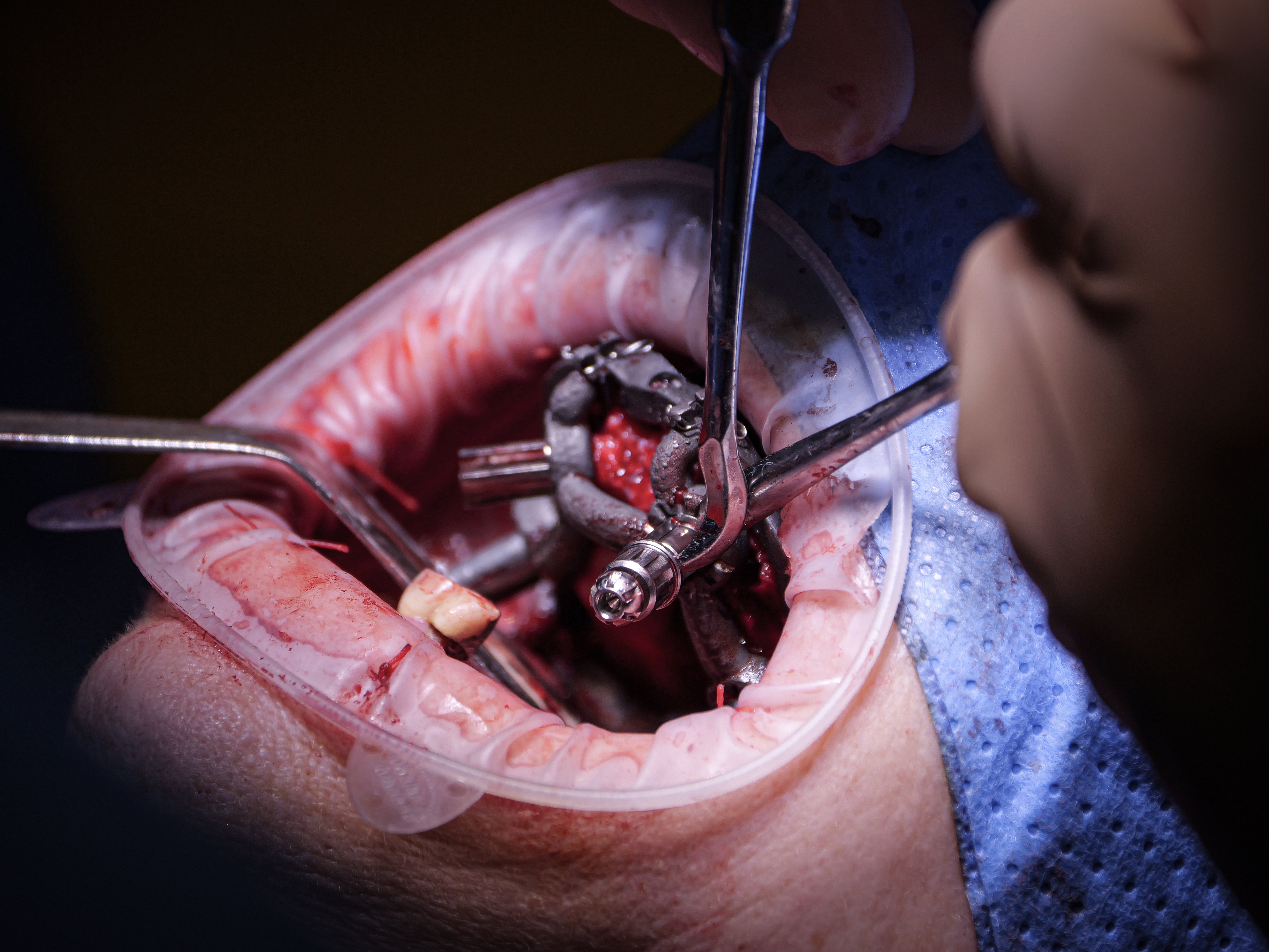 Implantologie et chirurgie pré-implantaire - Saison 1