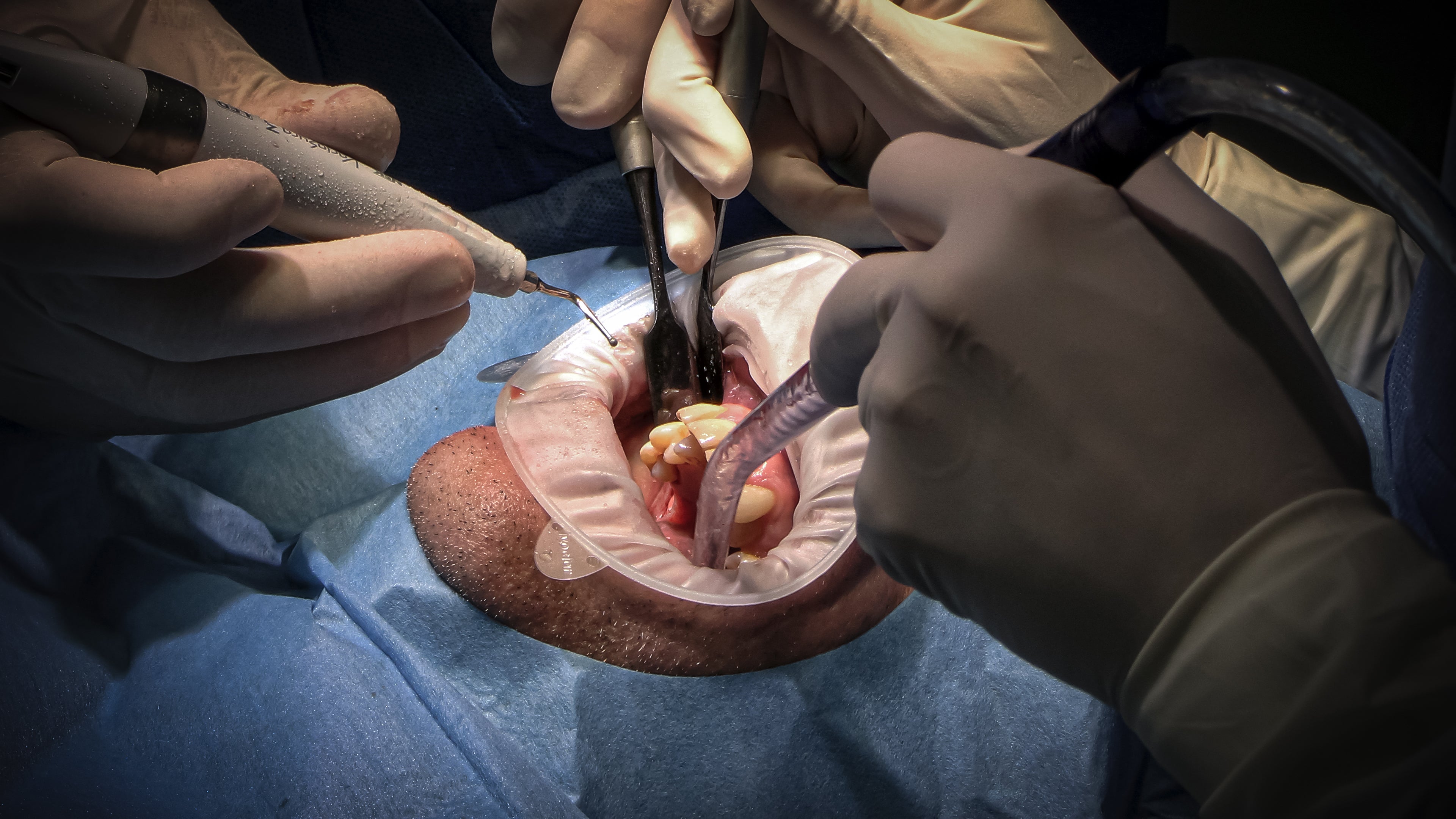 Implantologie et chirurgie pré-implantaire - Saison 1