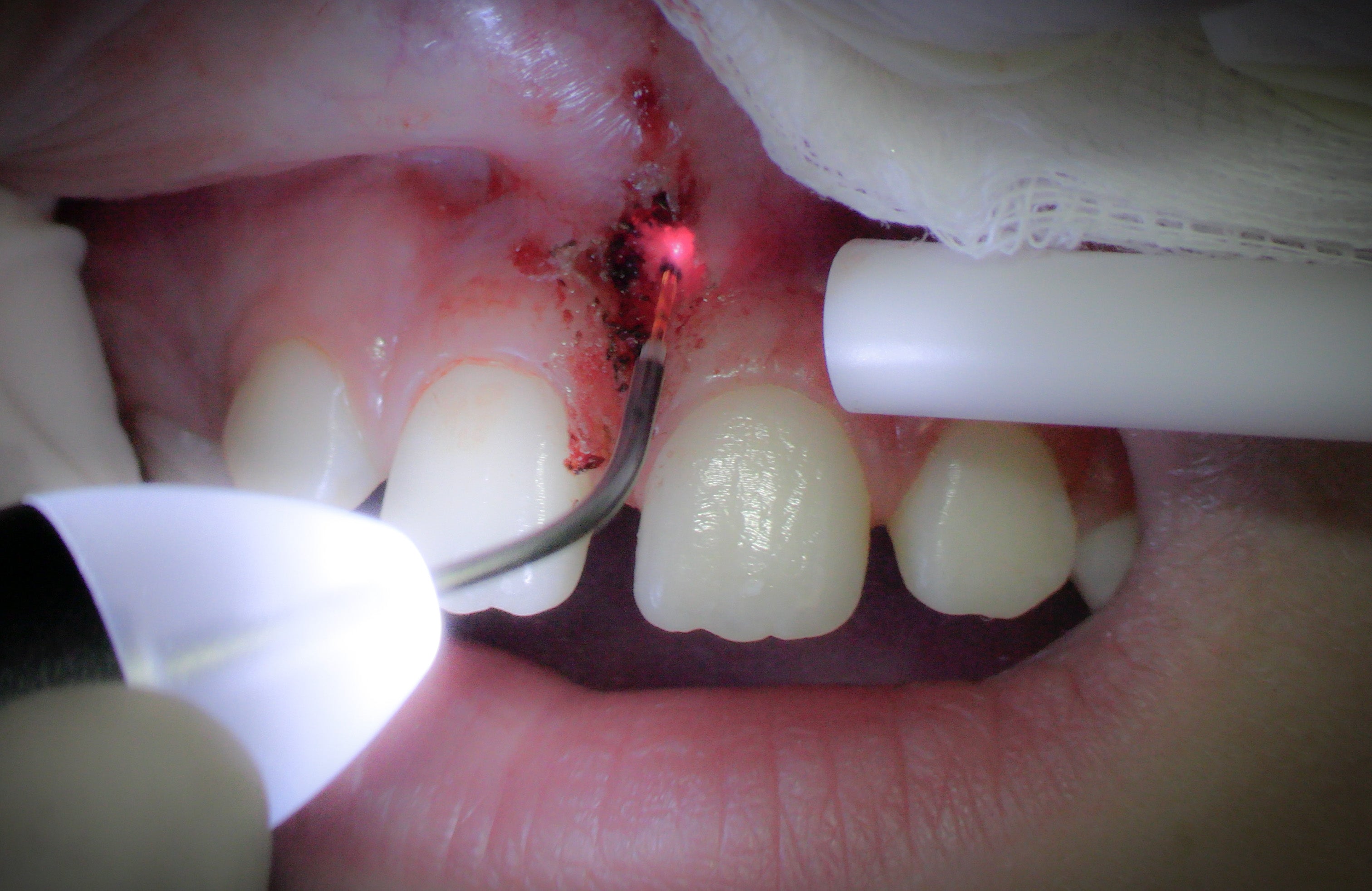 Parodontie & Chirurgie muco-gingivale - Saison 1