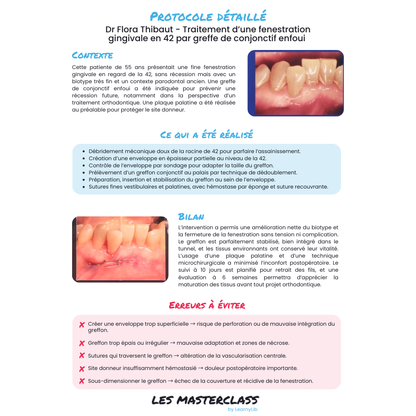 Parodontie & Chirurgie muco-gingivale - Saison 1