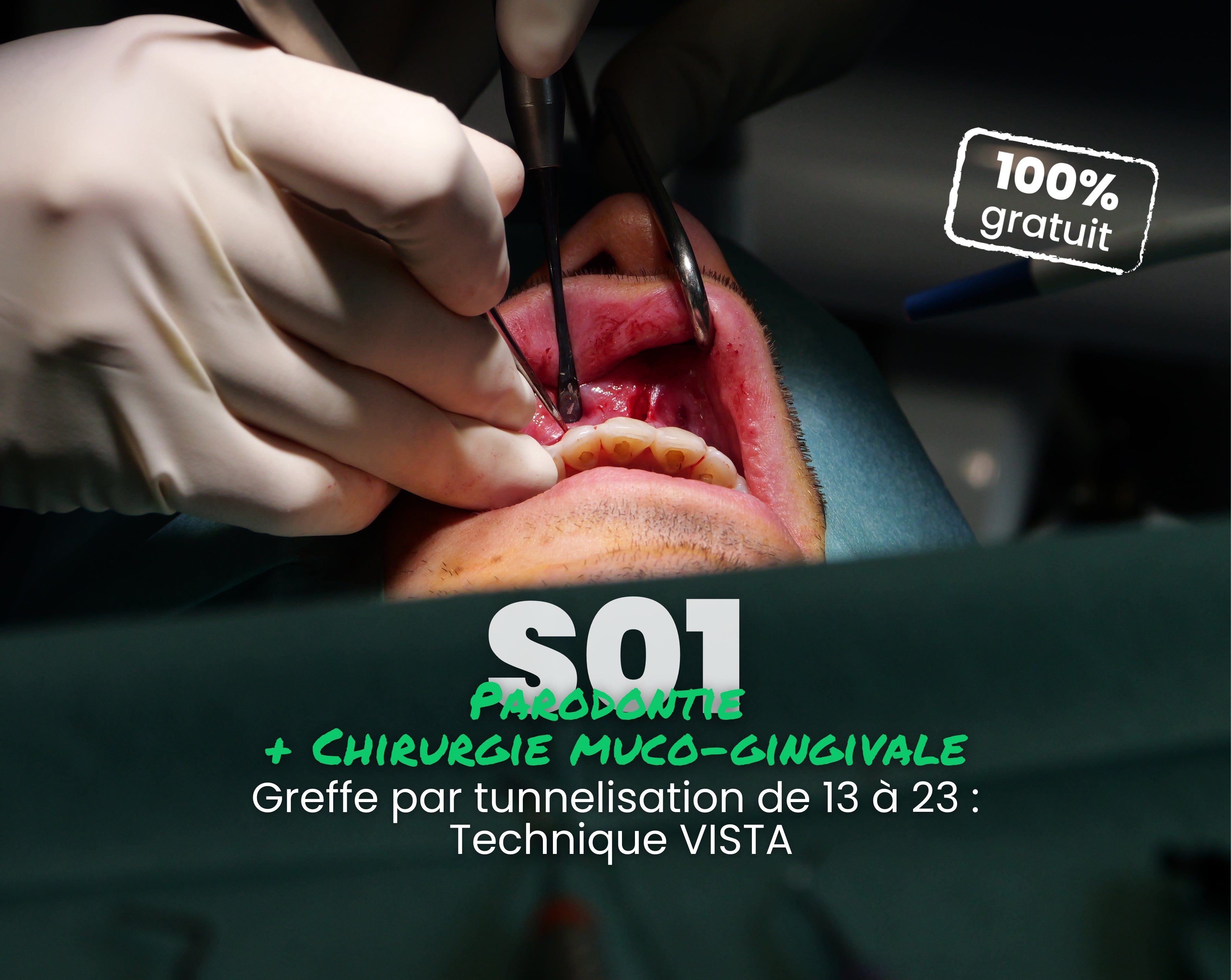 Extrait offert - MasterClass Parodontie & Chirurgie muco-gingivale Saison 1 - Greffe par tunnelisation de 13 à 23 : Technique VISTA