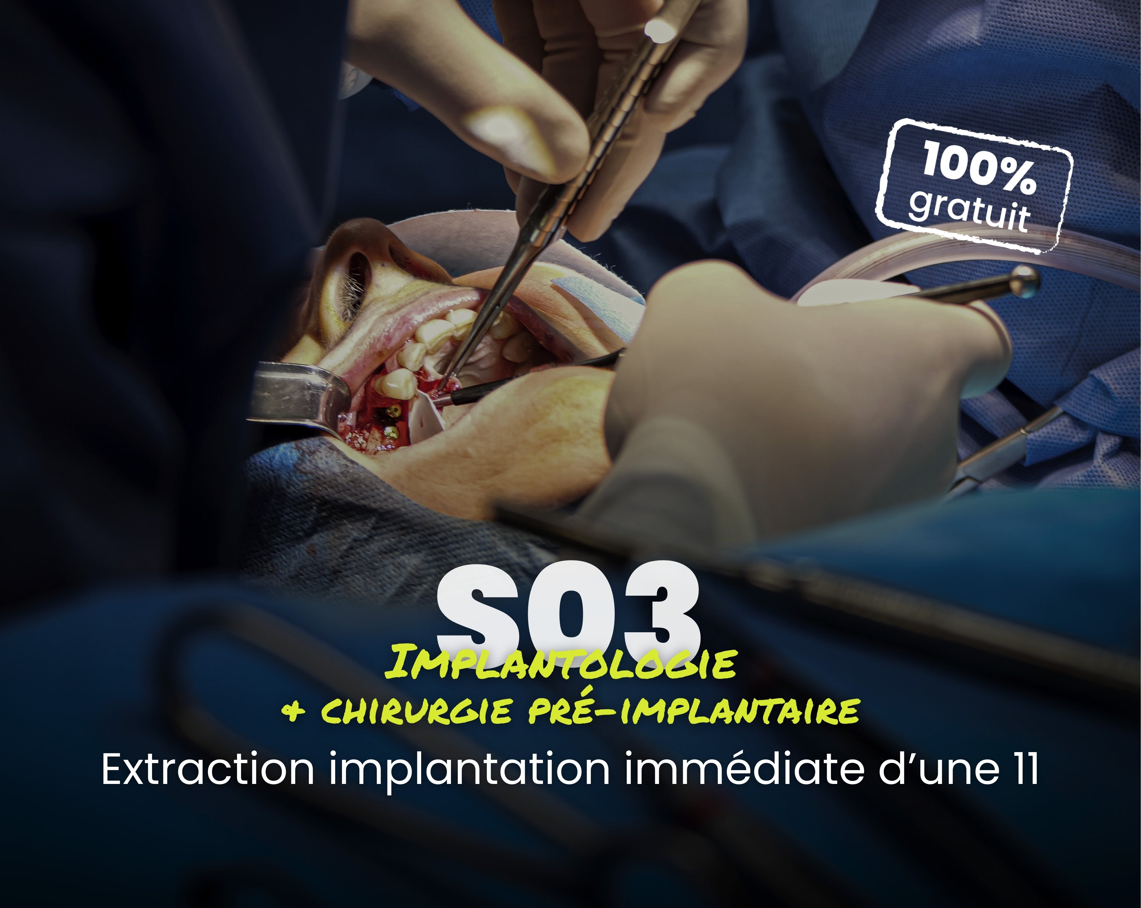 Extrait offert - MasterClass Implantologie Saison 3 - Extraction implantation immédiate d’une 11