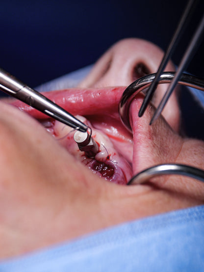 Implantologie et chirurgie pré-implantaire - Saison 1